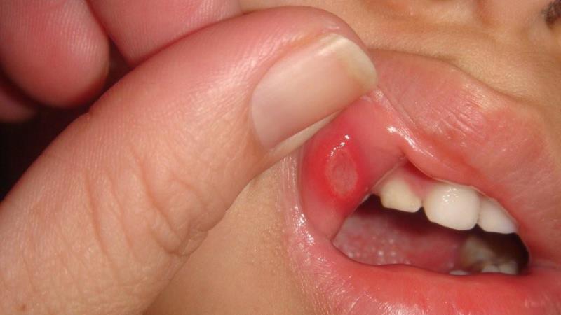 у ребенка белый прыщик во рту на щеке