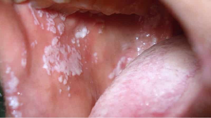 водянистый прыщик во рту