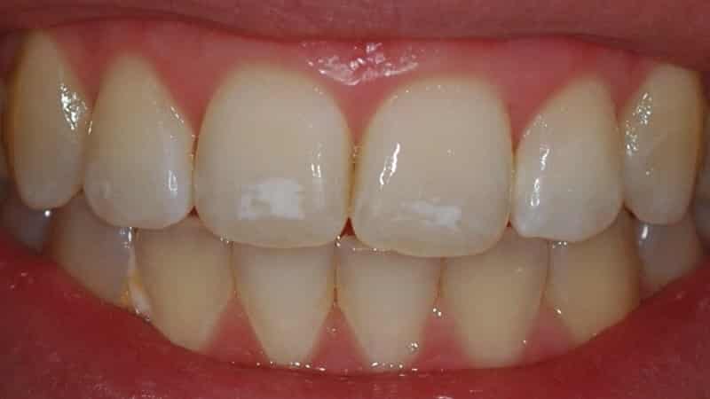 белые пятна на зубах у ребенка