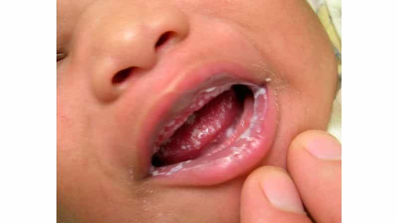 белый налет на губах по утрам после сна