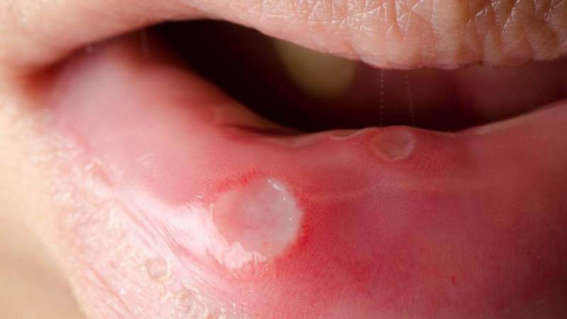 белый налет на губах причины