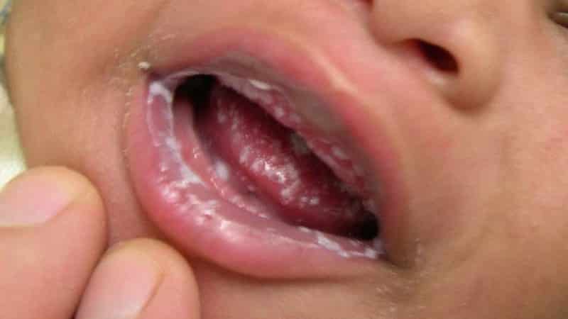 белый налет во рту у грудничка фото