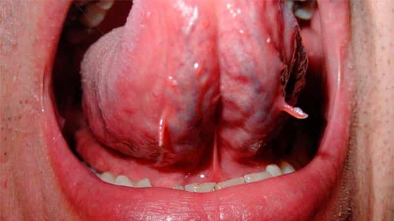 белый нарост на языке у человека