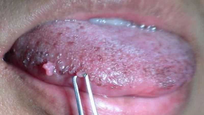 наросты под языком