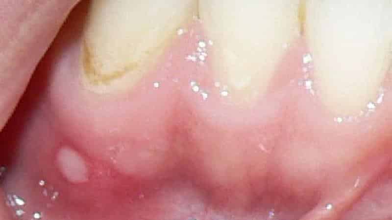 белый прыщик на десне у ребенка