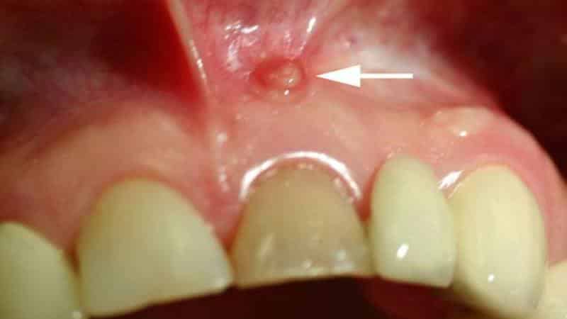 прыщ на десне над зубом
