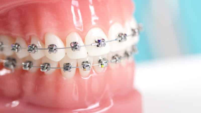 безлигатурные брекеты это