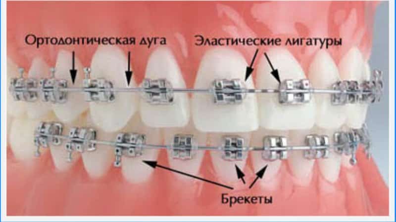 безлигатурные металлические брекеты