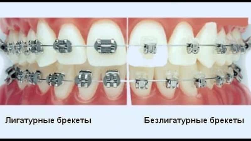 безлигатурные брекеты отзывы