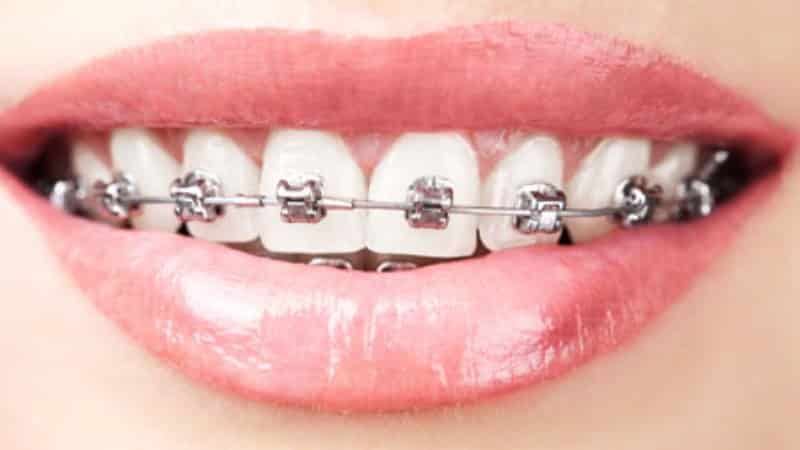 лигатурные брекеты и безлигатурные брекеты