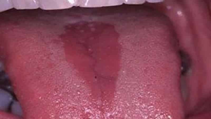 заболевание языка симптомы