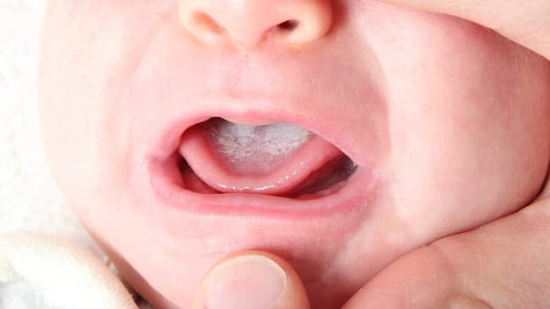 заболевание языка фото