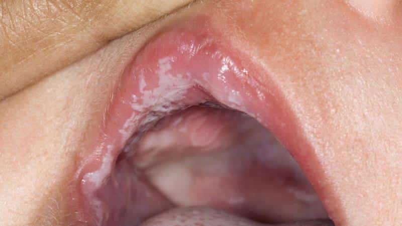 белый налет на деснах у взрослого