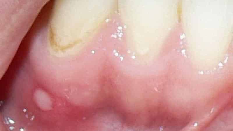 белые точки на деснах у взрослых