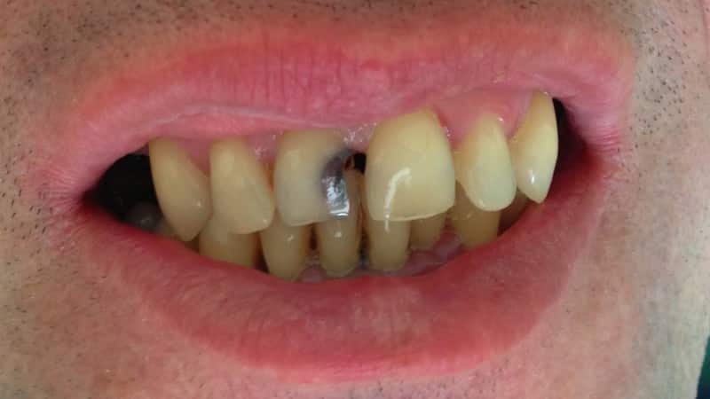 болит дырка в зубе что делать