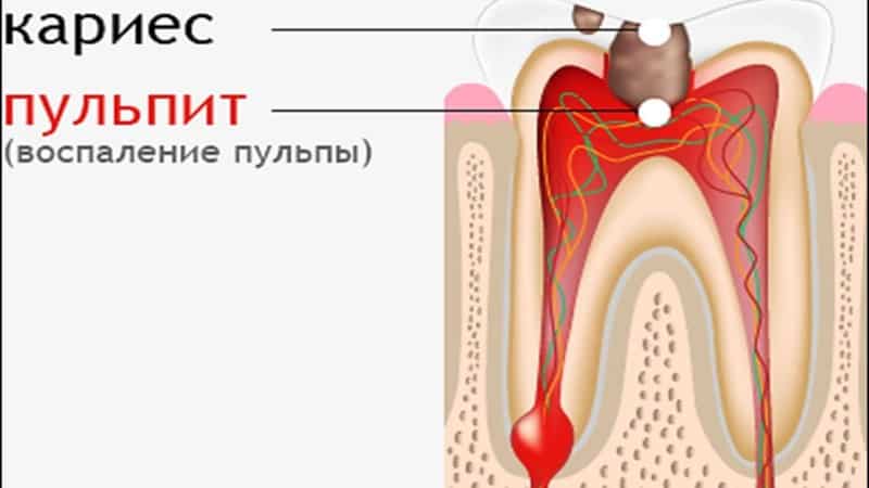 дырка в зубе сбоку