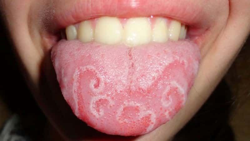 болит кончик языка чем лечить и что делать