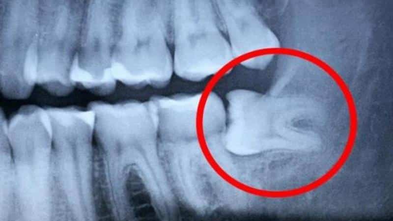 что делать если болит зуб мудрости при беременности