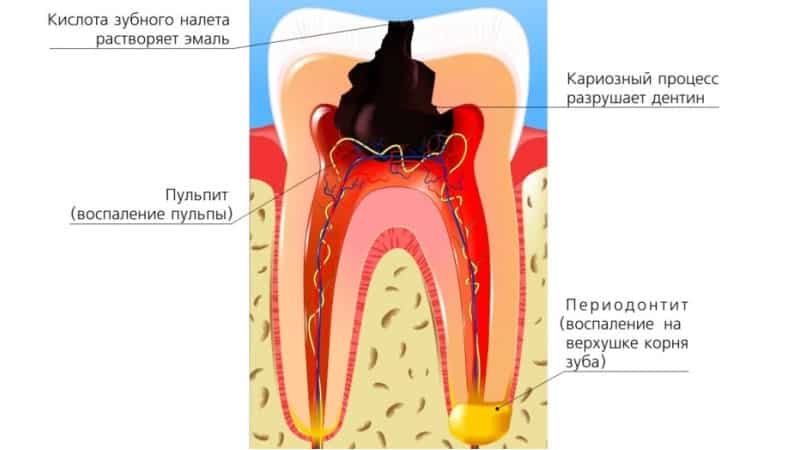 болит зуб после чистки каналов