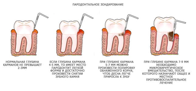 что делать если десна красная и сильно болит у основания возле зуба