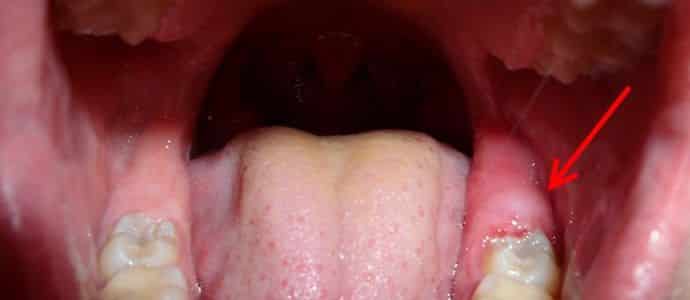 что делать когда лезет зуб мудрости болит десна как снять боль обезболить