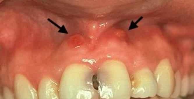 что делать если чешется ноет зуб под пломбой