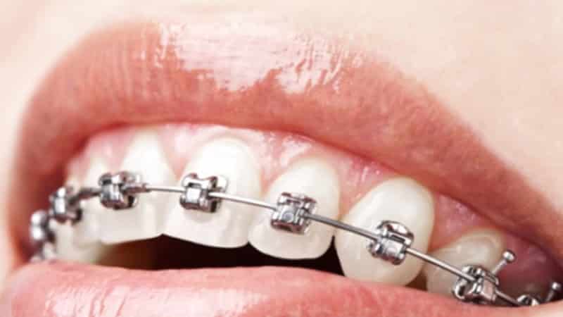 больно ли ставить брекеты на зубы