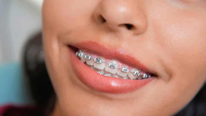 больно ставить брекеты