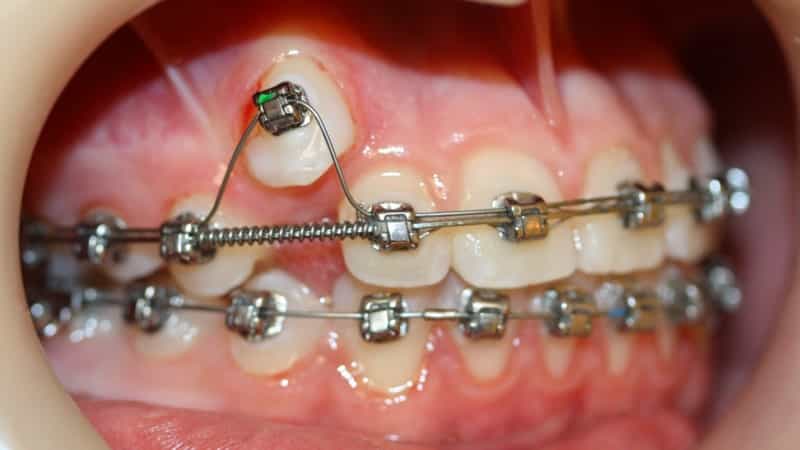 брекеты больно ли их носить