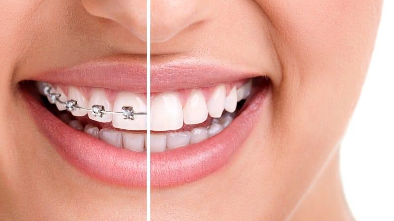 больно ли носить брекеты