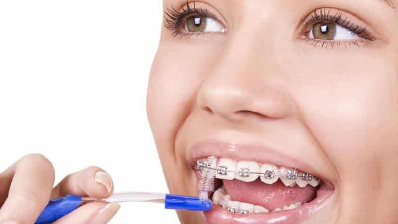 стоит ли ставить брекеты