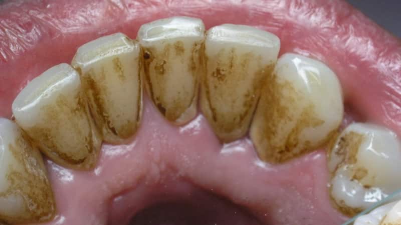 больно ли удалять зубной камень