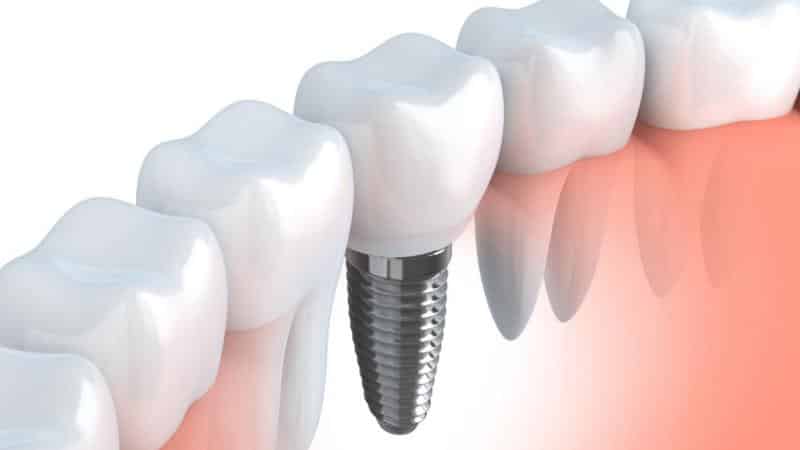 больно ли вставлять зубы