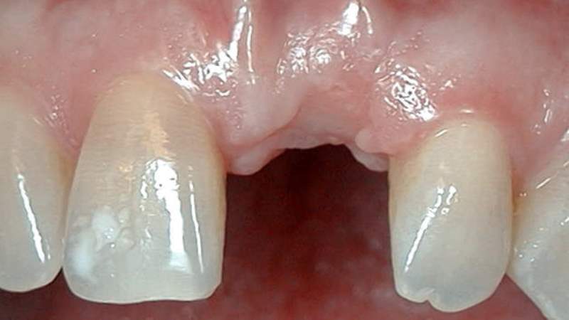 больно ли ставить импланты зубов