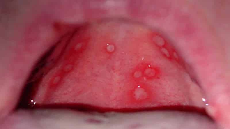 белая язва болячка на десне у ребенка фото лечение