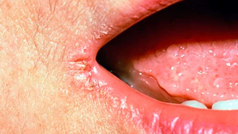 Болячки в уголках рта