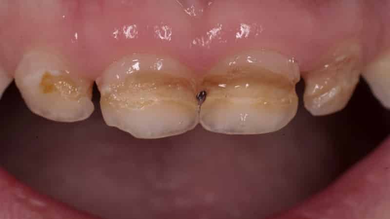 бутылочный кариес глубокое фторирование