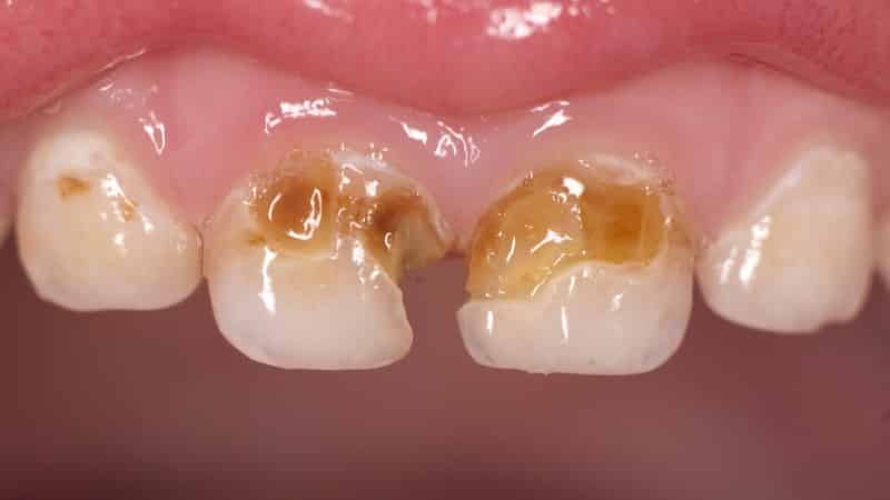 бутылочный кариес у детей фото