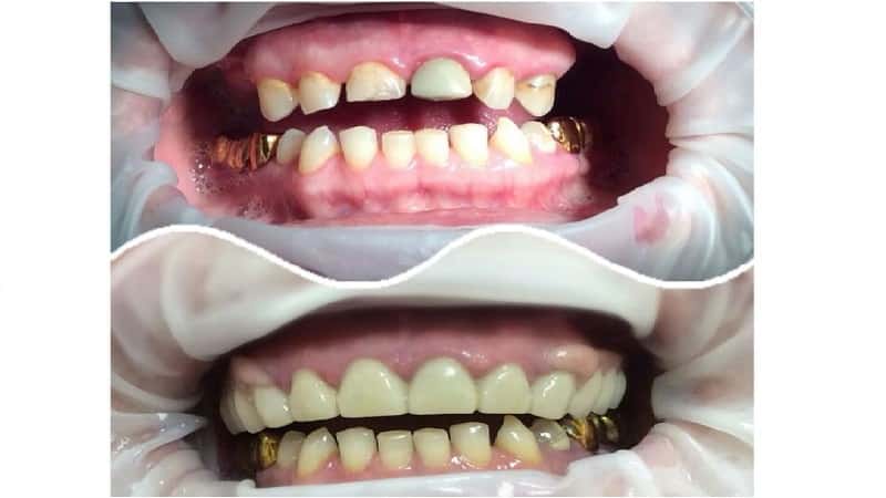 зубной протез квадротти
