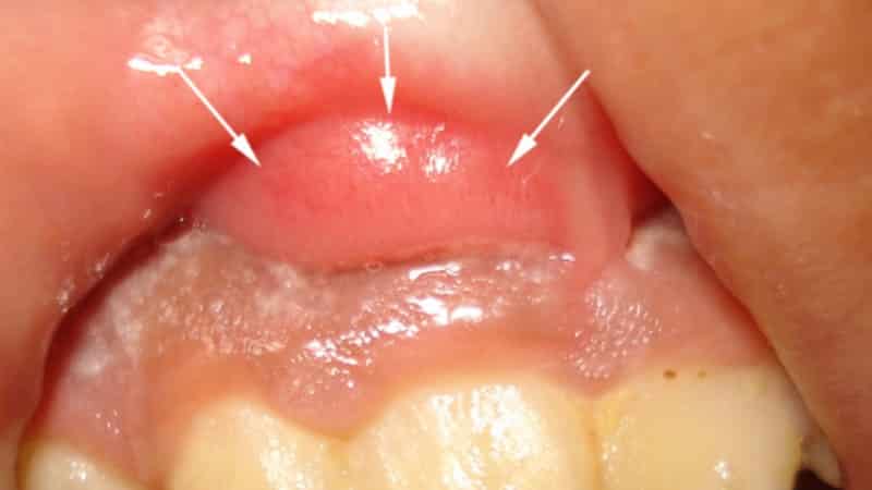 чем и как снять опухоль с десны в домашних условиях