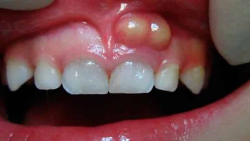 у ребенка опухла десна над зубом как снять опухоль