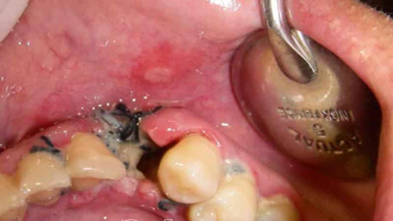 опухла десна над зубом