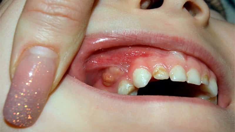 опухшие десна у ребенка фото