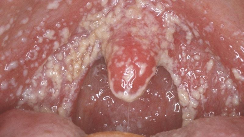 стоматит чем полоскать рот