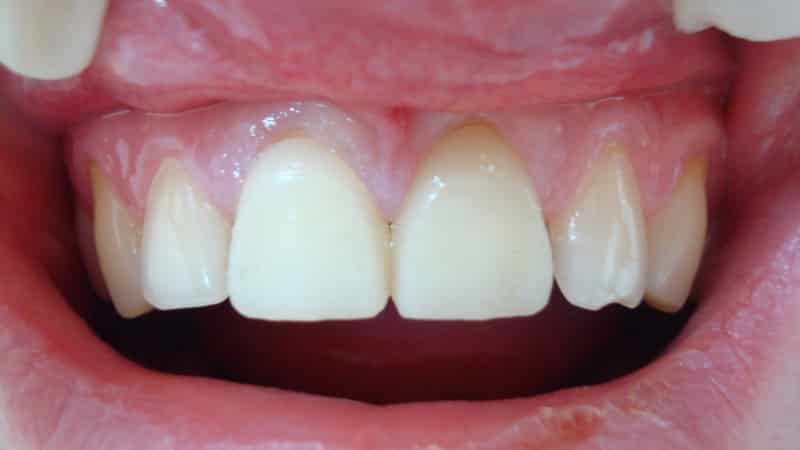 Виды коронок