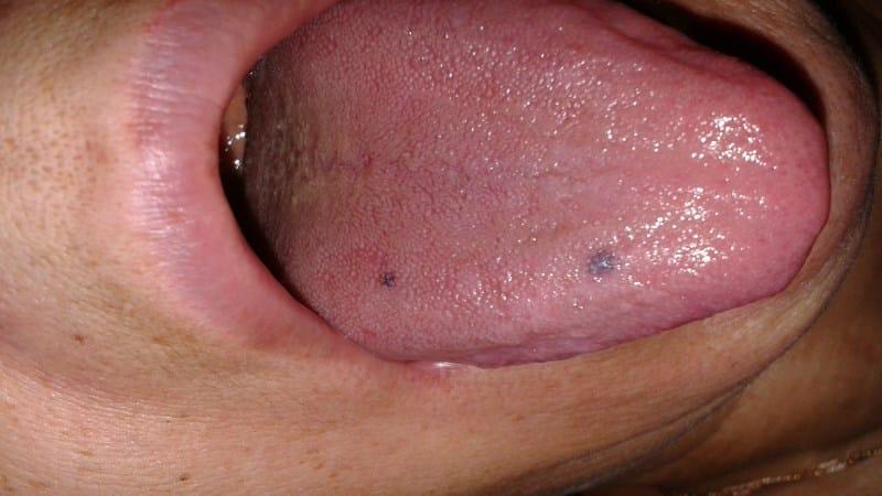 черная точка на языке что это