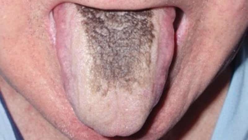 черное пятно на языке у человека
