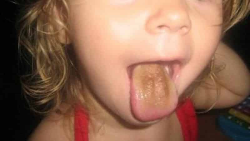 черные точки на языке