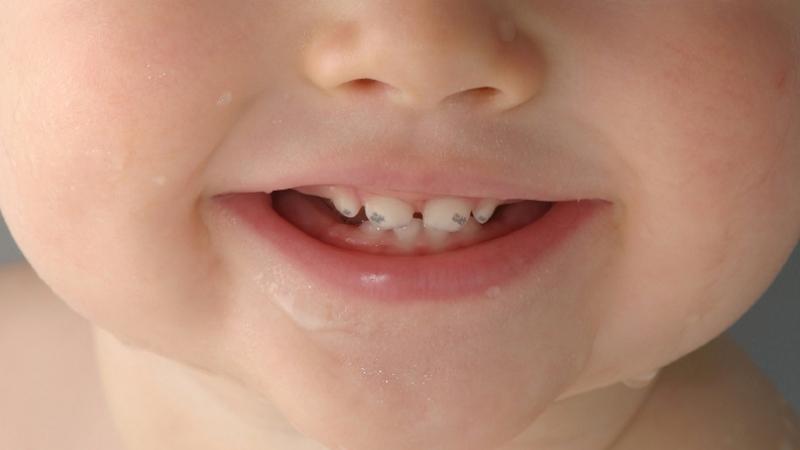 появились темные пятна на зубах