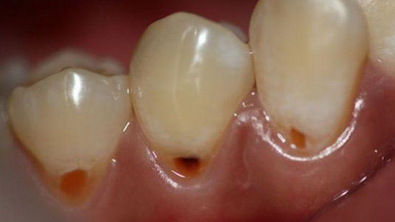 черное пятно на зубе